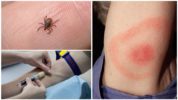 Xét nghiệm máu cho borreliosis sau khi bị ve cắn