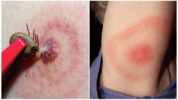 Bệnh Lyme hoặc borreliosis do ve gây ra