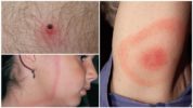 Những dấu hiệu đầu tiên của bệnh borreliosis