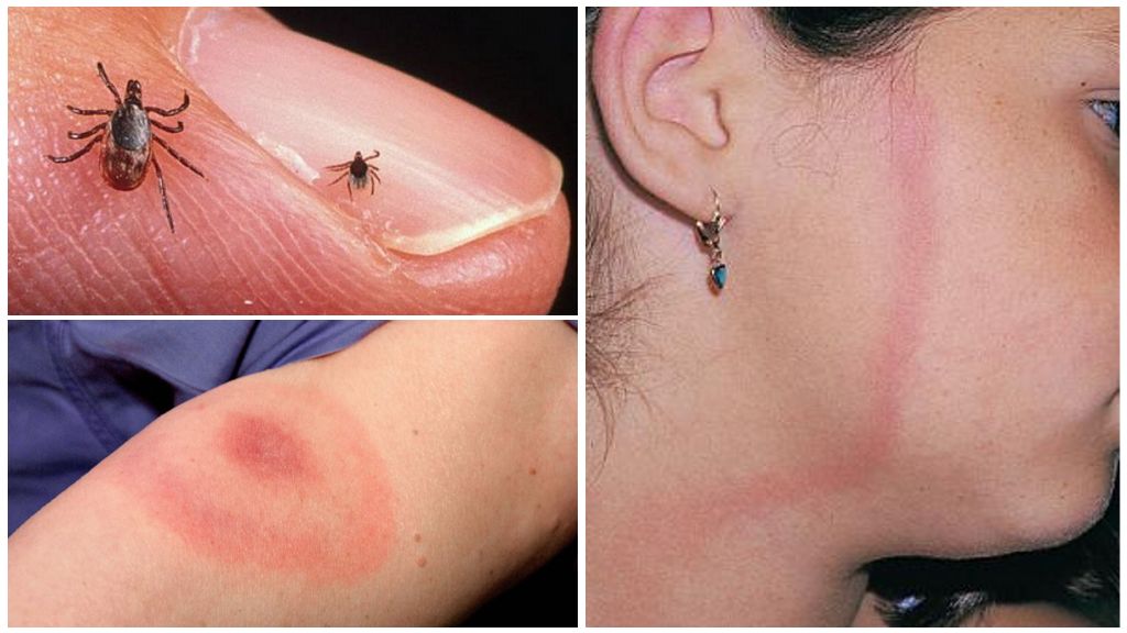 Triệu chứng borreliosis bẩm sinh, hậu quả và phòng ngừa ở người lớn