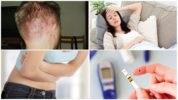 Nguyên nhân gây ra demodicosis của da đầu