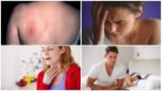 Triệu chứng của bệnh Borreliosis