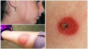 Bệnh Lyme