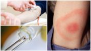 Chẩn đoán phòng thí nghiệm borreliosis