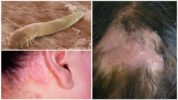 Triệu chứng demodicosis của đầu