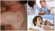 Điều trị bệnh borreliosis ở trẻ em