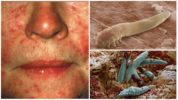 Đánh dấu vào mặt Demodex