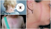 Giai đoạn đầu tiên của bệnh borreliosis ở trẻ